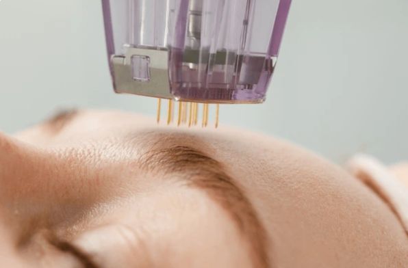 https://hydrationcorner.com/wp-content/uploads/2024/04/us-spa-microneedle.jpg